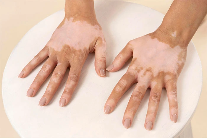 generalized--vitiligo